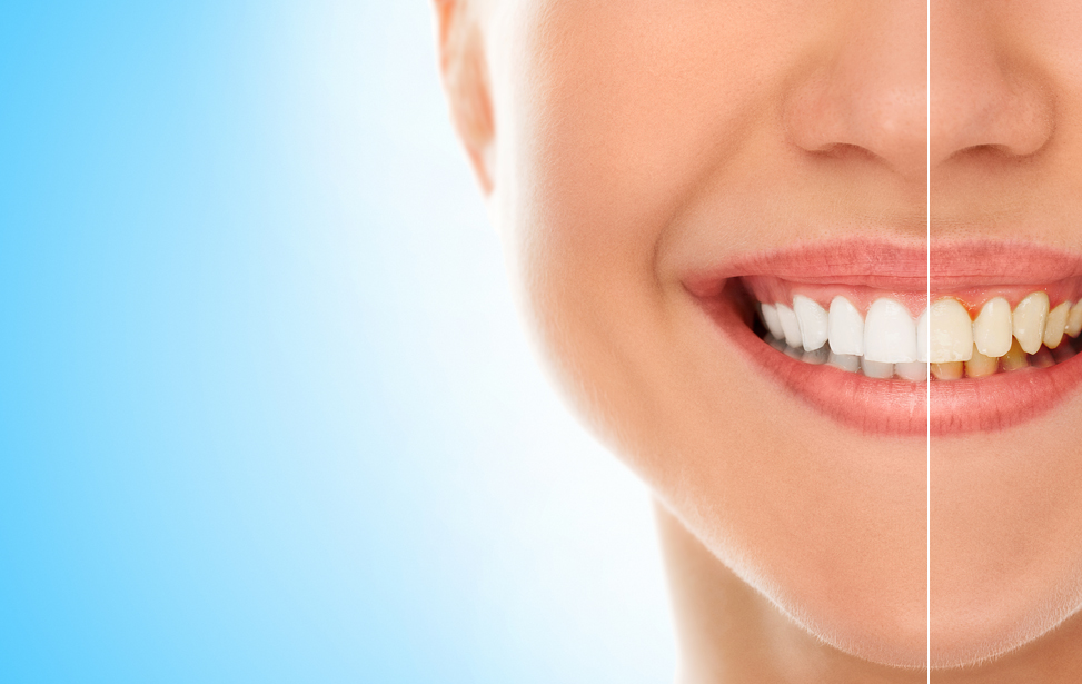 Teeth Whitening and Bleaching