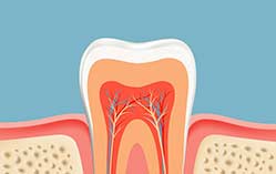 Root Canal Therapy