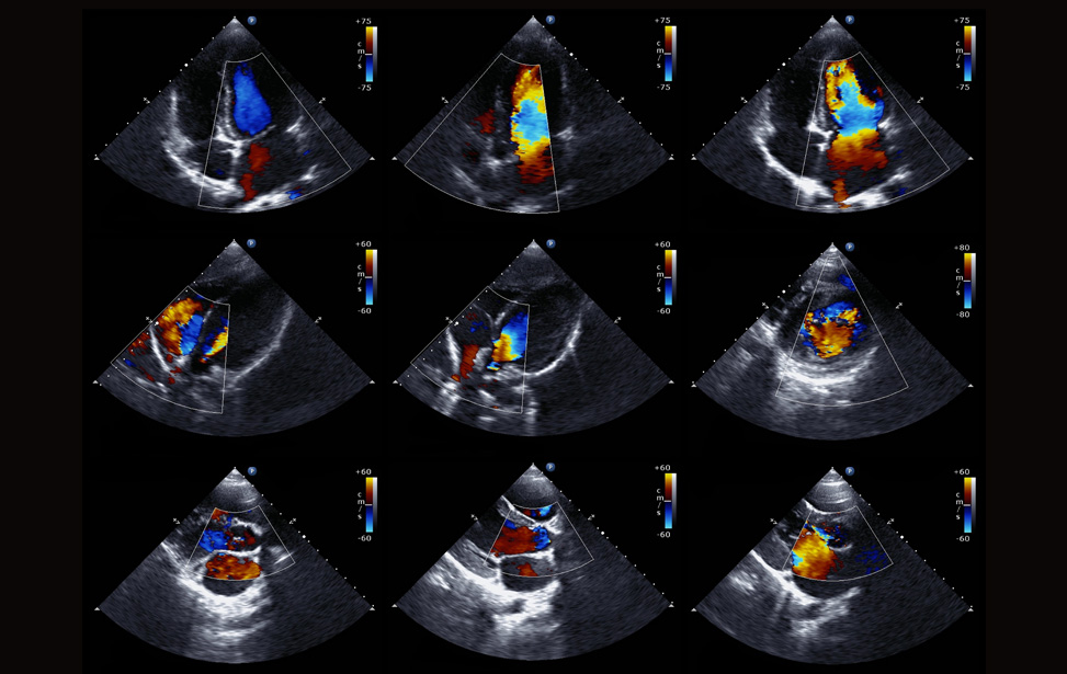 2D/4D ECHO COLOR DOPPLER