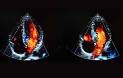 Echocardiogram (ECG)